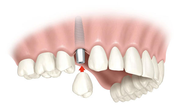 dental-implants-aliso-viejo-e1409287432391